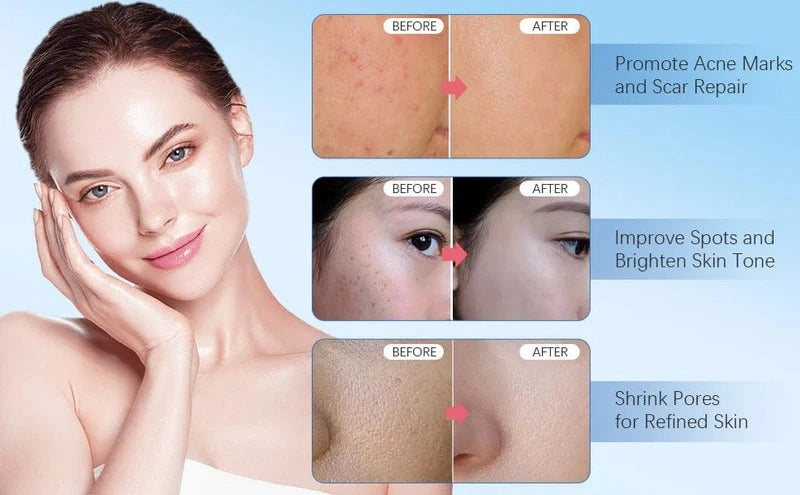 Woman with clear skin showing before and after effects on a blue background
