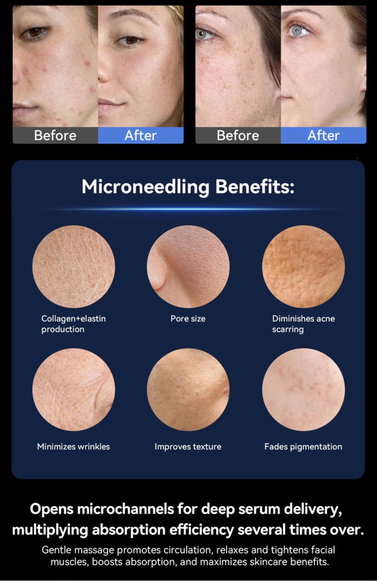 A promotional graphic for a microneedling skincare treatment. The top section shows before-and-after facial close-ups demonstrating clearer skin after treatment.